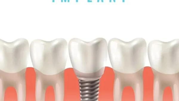 Dental Implants – Get Health Care Tips
