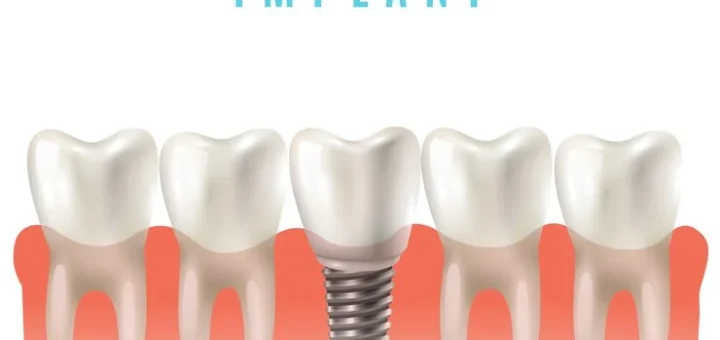 Dental Implants – Get Health Care Tips
