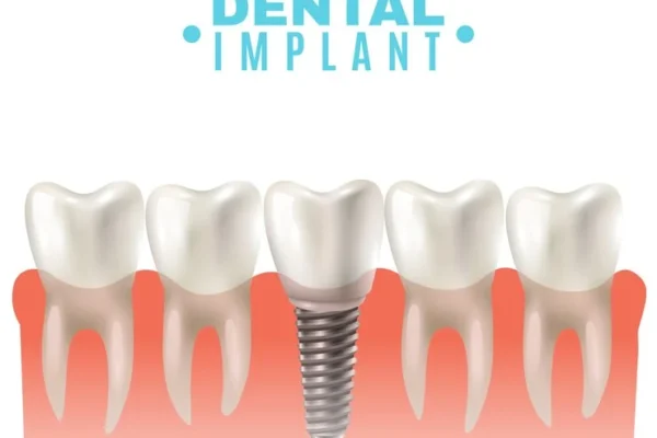 All That You Should Know About Dental Implants
