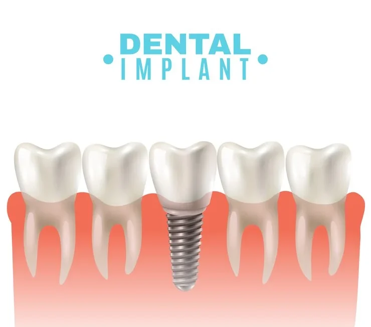 All That You Should Know About Dental Implants