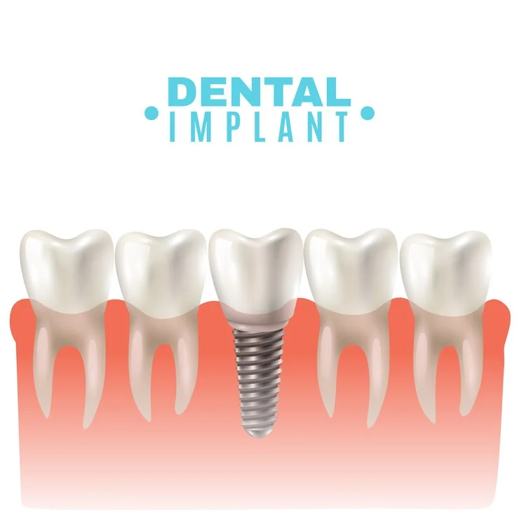 Dental Implants Guide