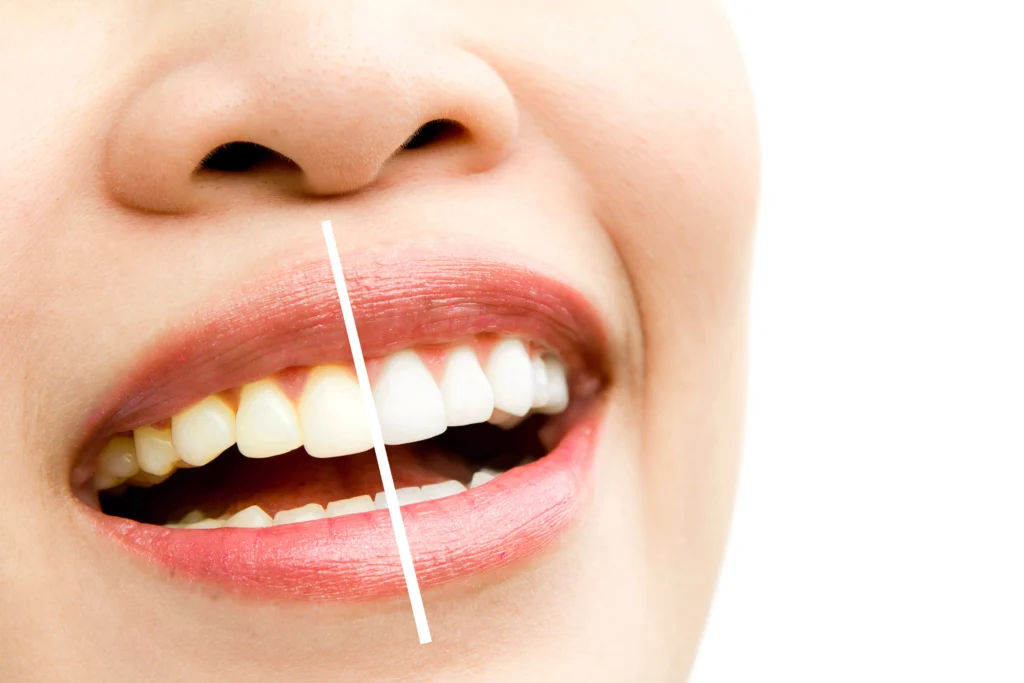 Teeth Whitening in Mumbai